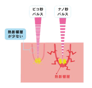 ピコレーザー エンライトンiii Hpcひまわり美容クリニック